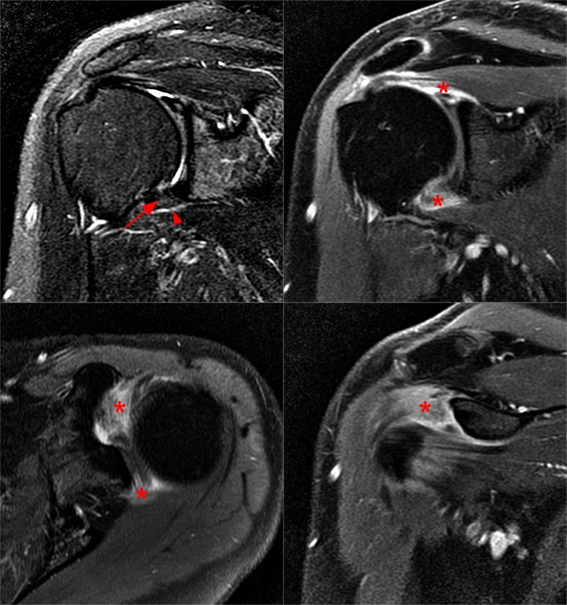 Adhesive Capsulitis Freezing Stage at Teresa Steele blog