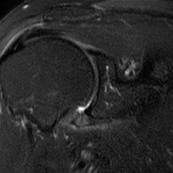 Adhesive Capsulitis of the Shoulder Radsource