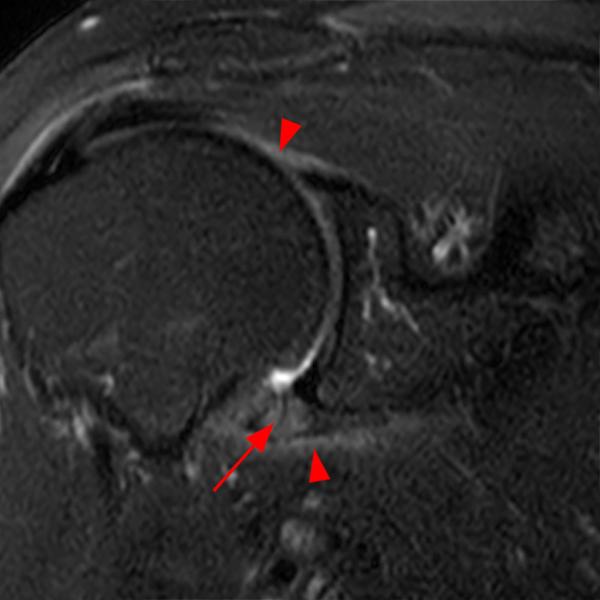 Adhesive Capsulitis of the Shoulder Radsource
