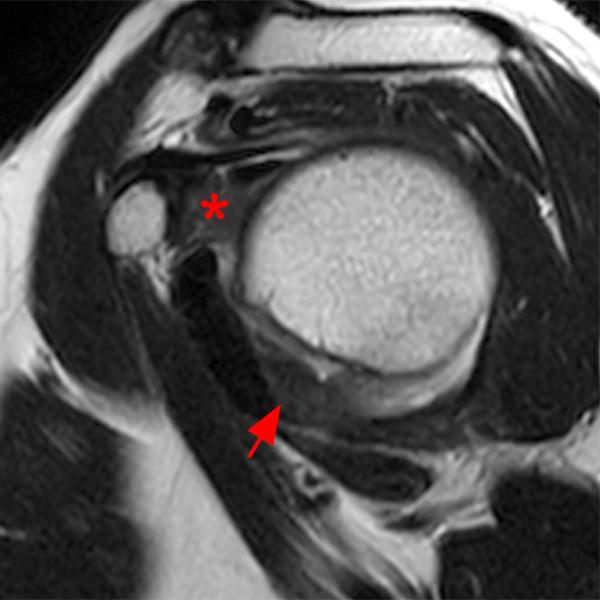Adhesive Capsulitis of the Shoulder Radsource