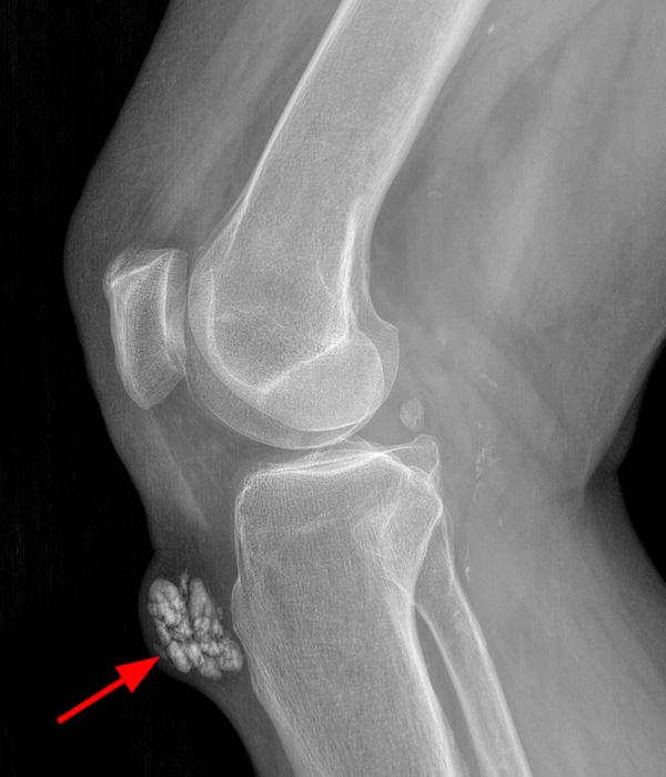 Knee Bursae Radsource