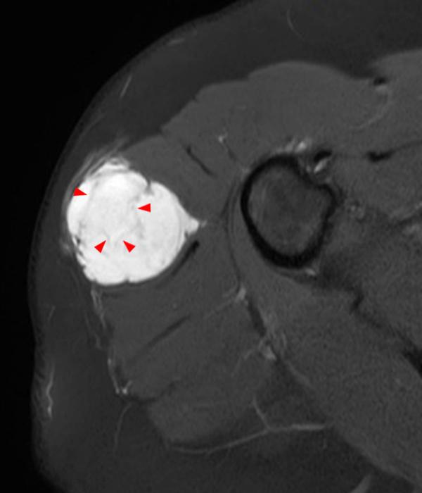 Myxoid SoftTissue Neoplasms Radsource