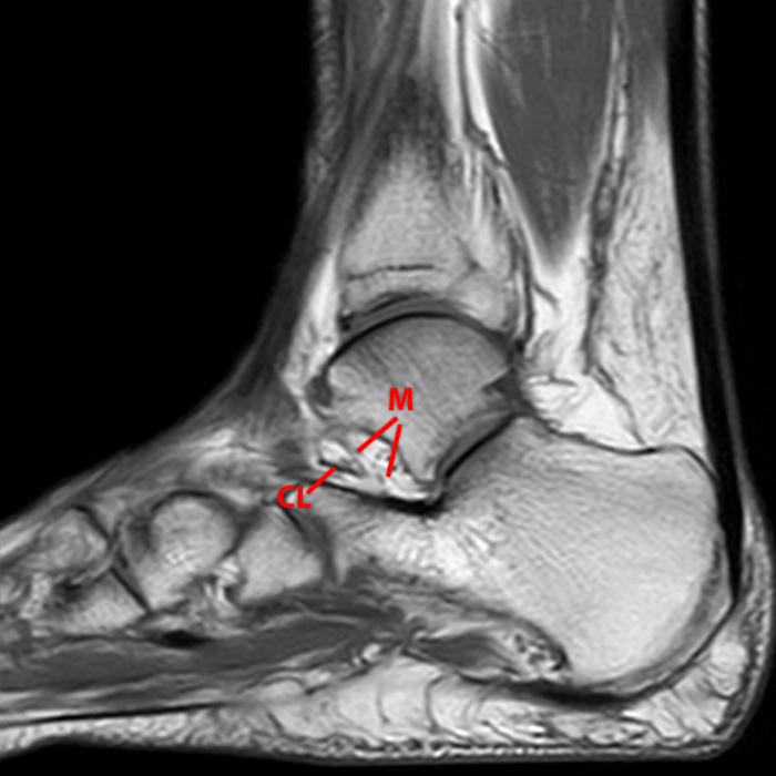 Sinus Tarsi Syndrome Radsource