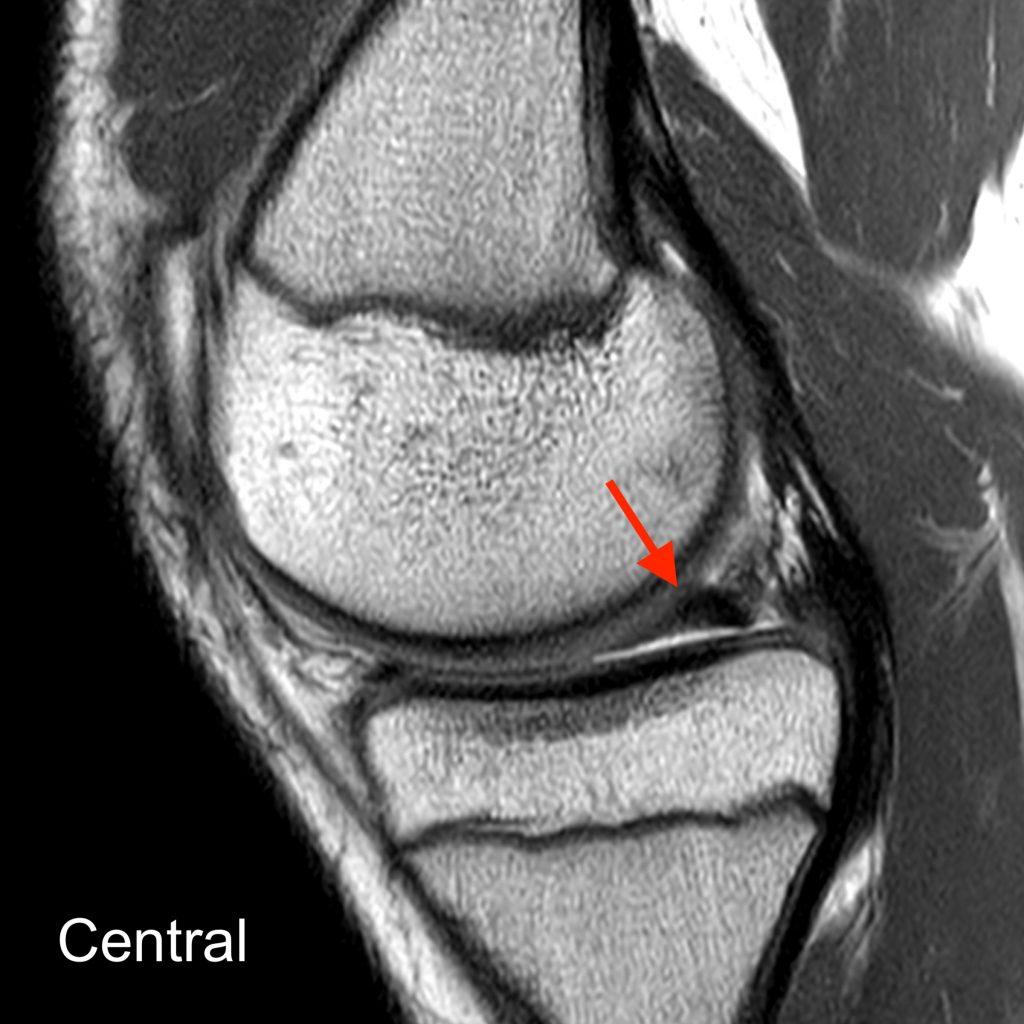 Buckethandle Tear of the Meniscus Radsource