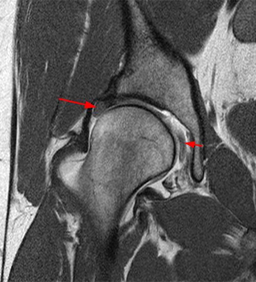 Developmental Dysplasia of the Hip Radsource