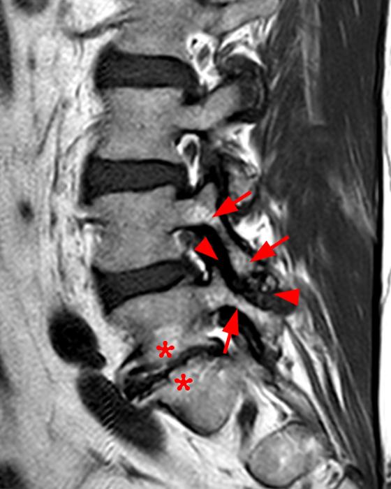 Facet Synovitis Radsource