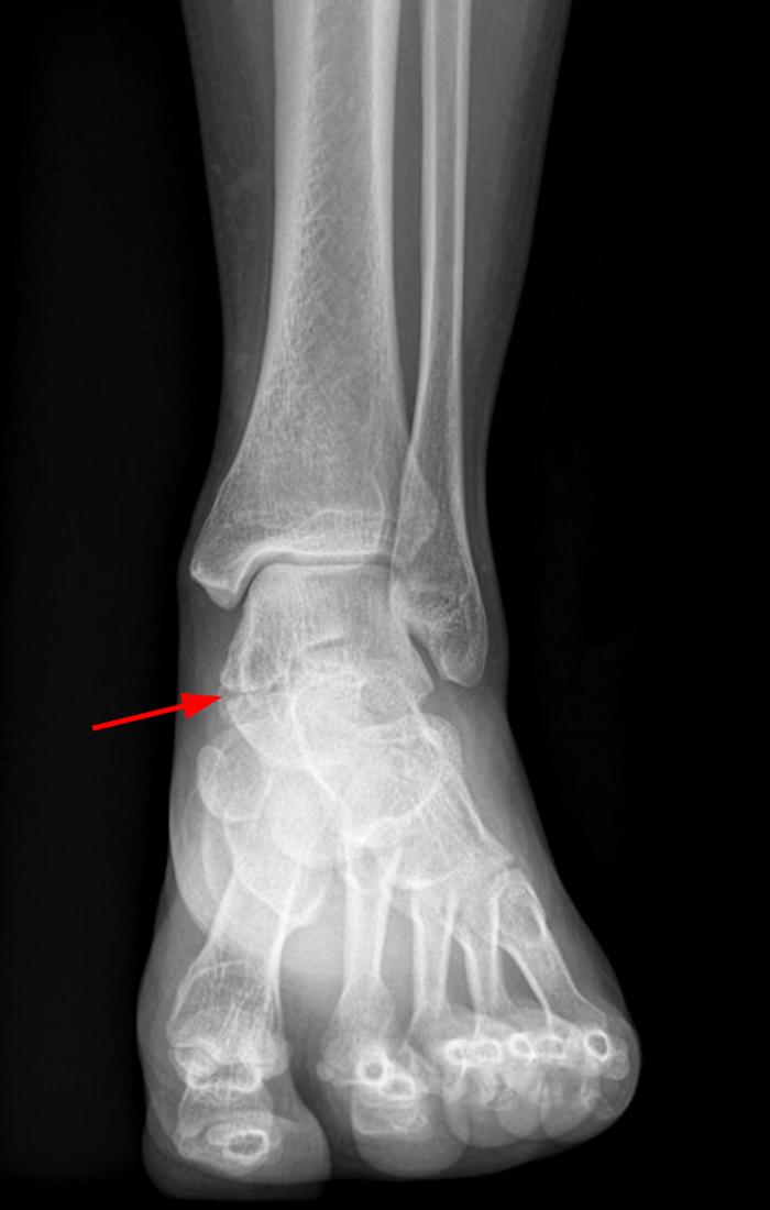 Developmental Talocalcaneal Coalitions and Associated Conditions Radsource