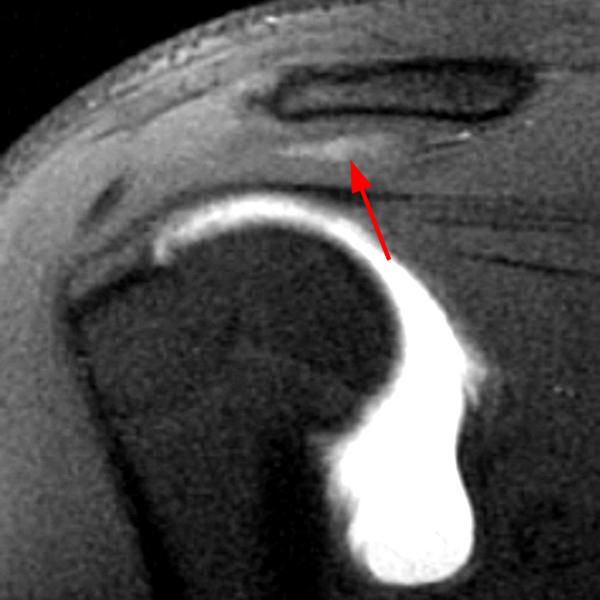 Shoulder Cysts Radsource