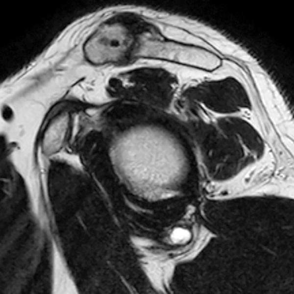 Shoulder Cysts Radsource