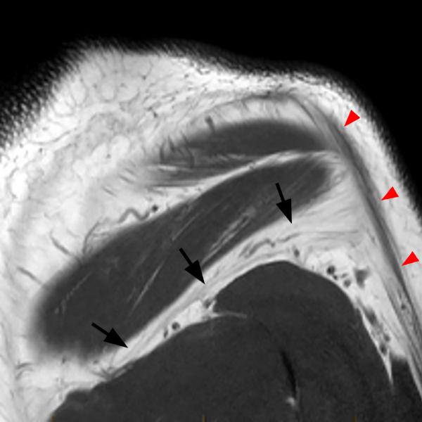 Shoulder Cysts Radsource