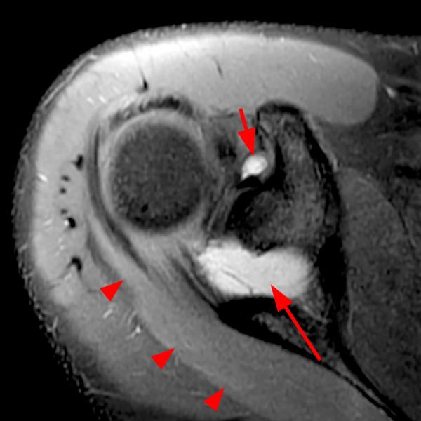 Shoulder Cysts Radsource