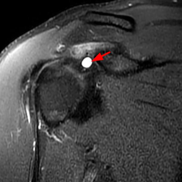 Shoulder Cysts Radsource