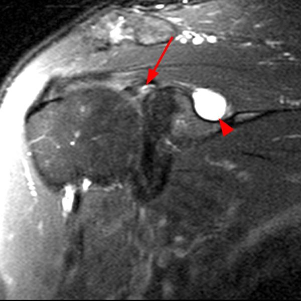 Shoulder Cysts Radsource