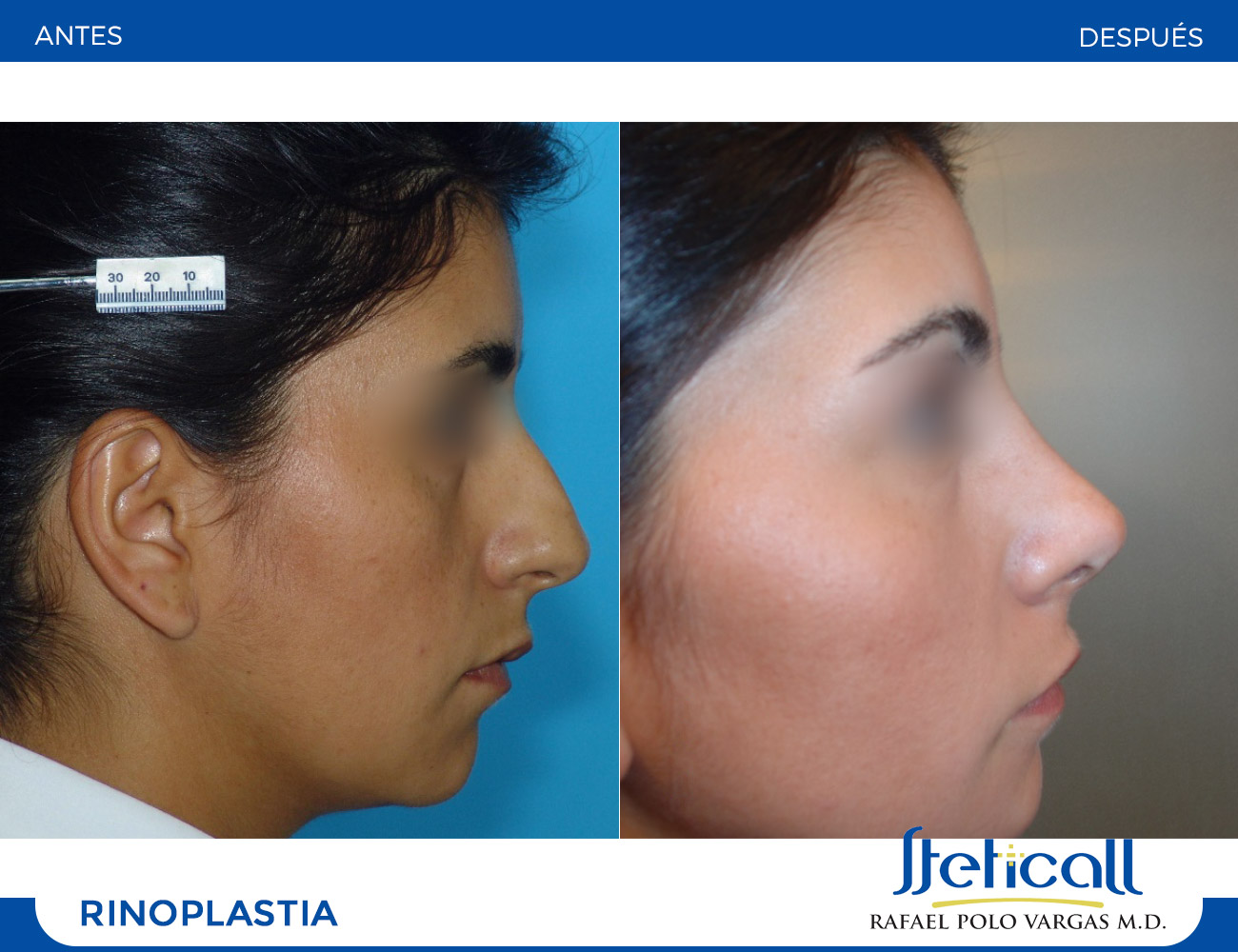 Rinoplastia y Septorrinoplastia Dr. Rafael Polo