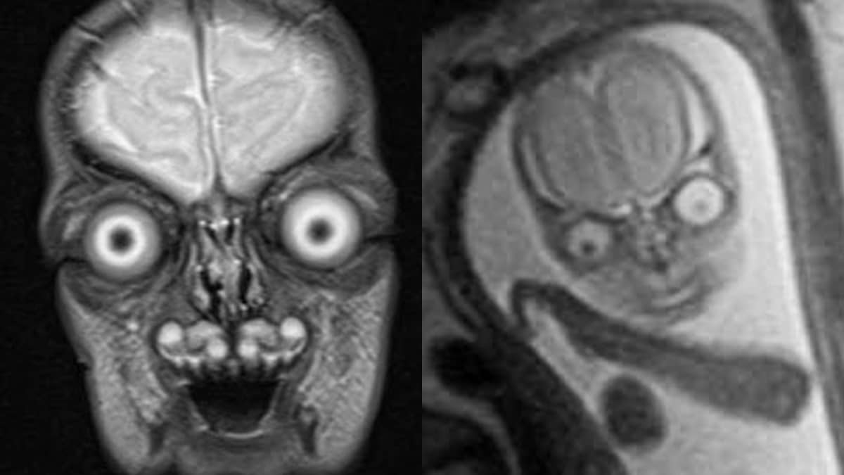 Imej MRI Scan Baby Bikin Seram, Siap Mata Terjojol Raja Lepak