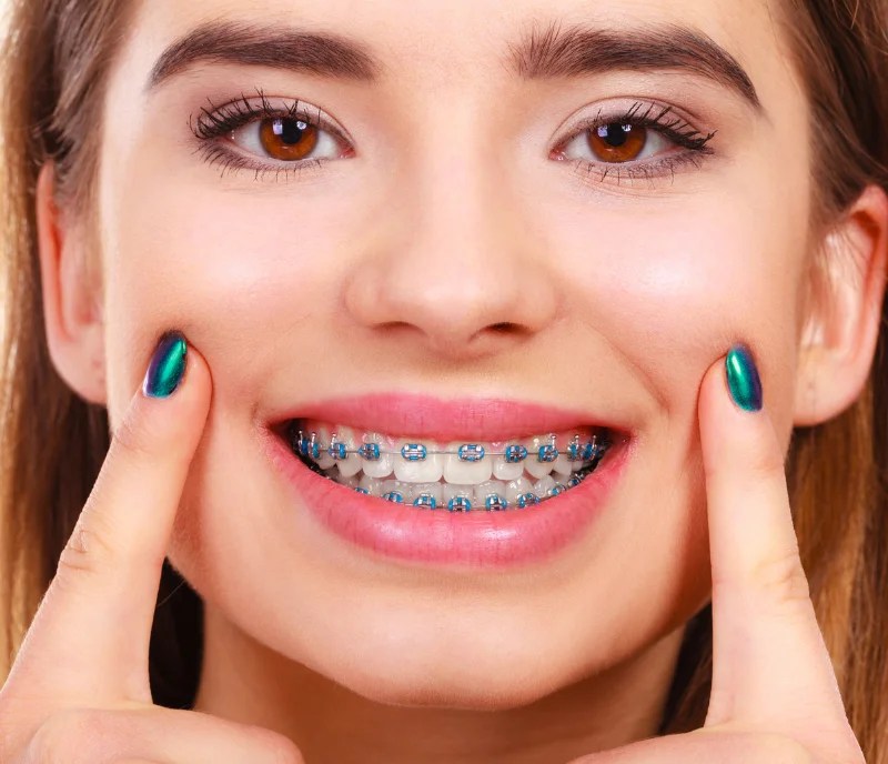 Dental Braces in Dubai Metal and Ceramic Braces RamaCare PolyClinic