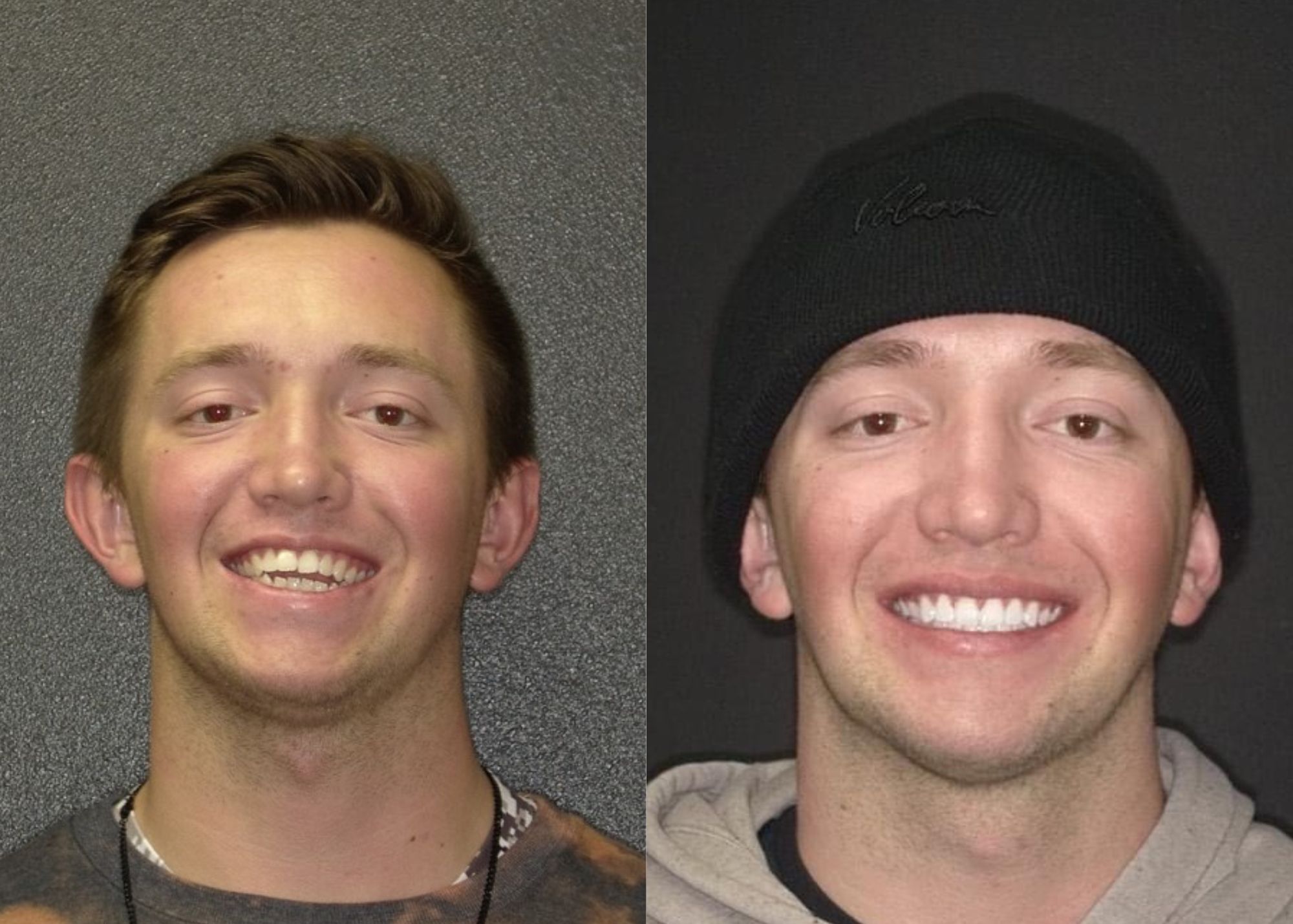 Orthodontic Expenses What Braces Cost Randall Orthodontics