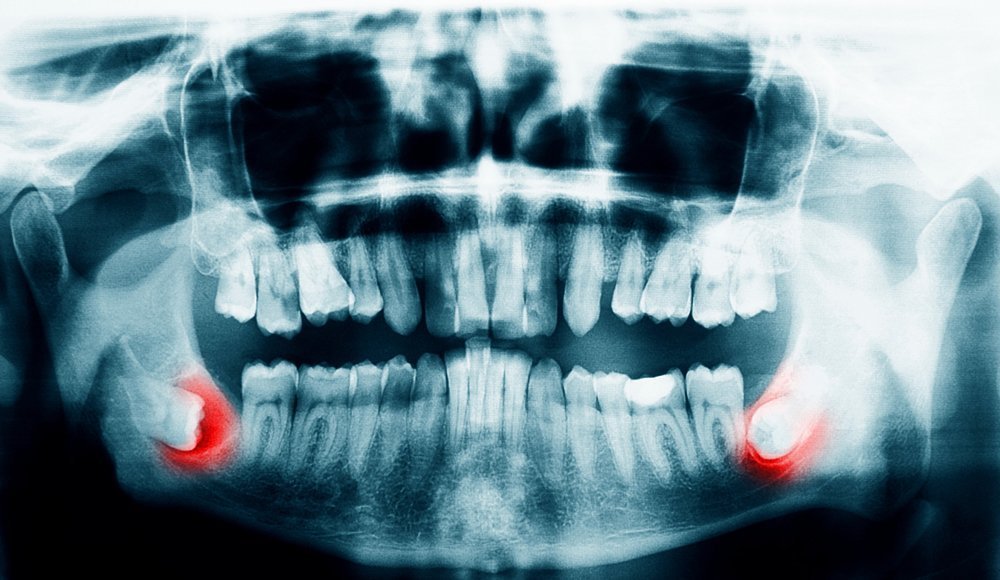 Should You Have Your Wisdom Teeth Removed Before Getting Braces in