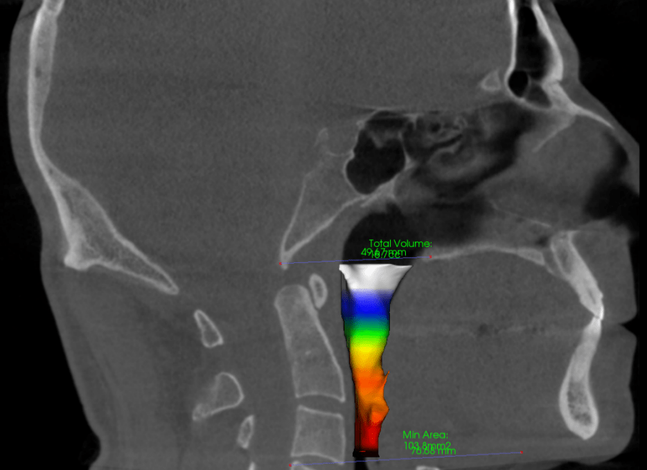 sleepapnea sleep apnea summary