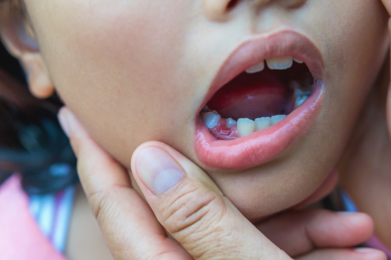 3 Most Common Reaons Why Baby Teeth Don't Fall Out