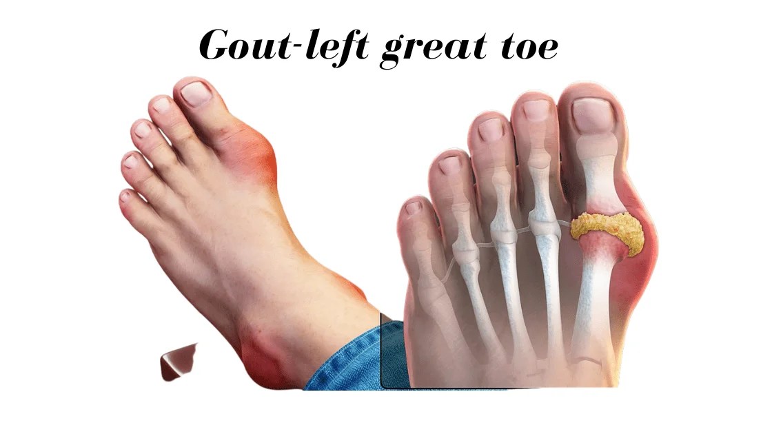 Gout 8 Things You Need To Know To Prevent And Treat It