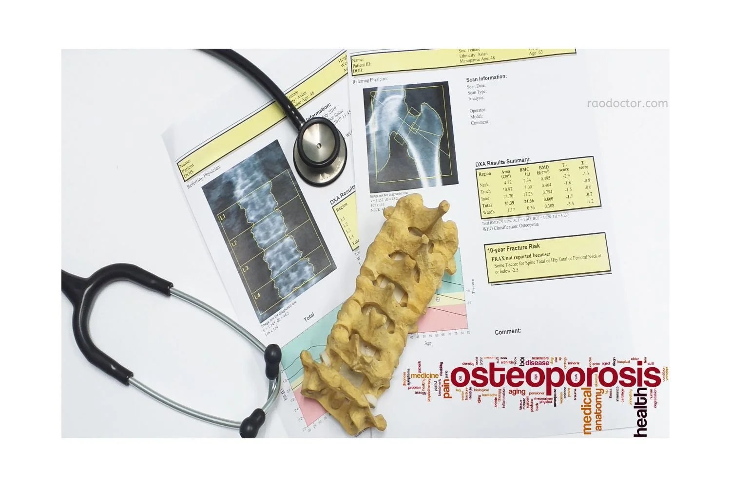 How To Know If You Have Osteoporosis, Osteopenia Or Osteomalacia