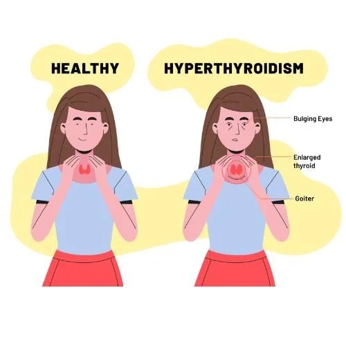 5 Signs, Symptoms Of Hyperthyroidismhow To Diagnose And Manage It