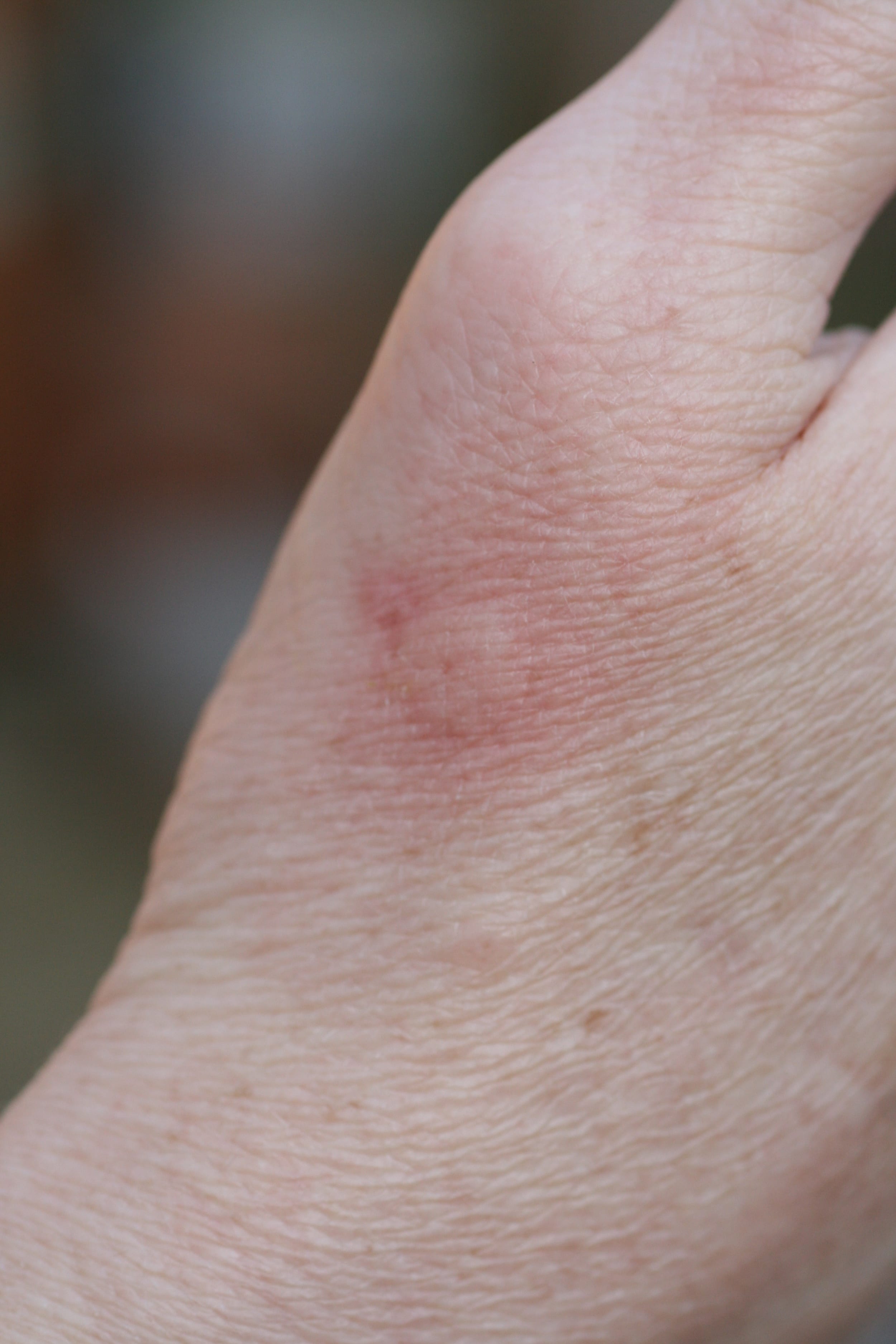 Bee+Sting+_+Normal+Reaction.jpgBee+Sting+_+Normal+Reaction Rapid Pest