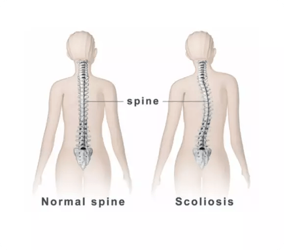 Scoliosis Treatment Rapid Physiocare