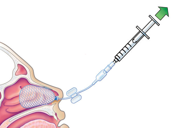 RAPID RHINO Arthrocare Product Usage Instructions For Epistaxis Events