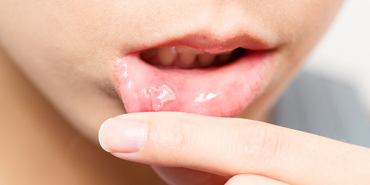 Std White Spots On Lips