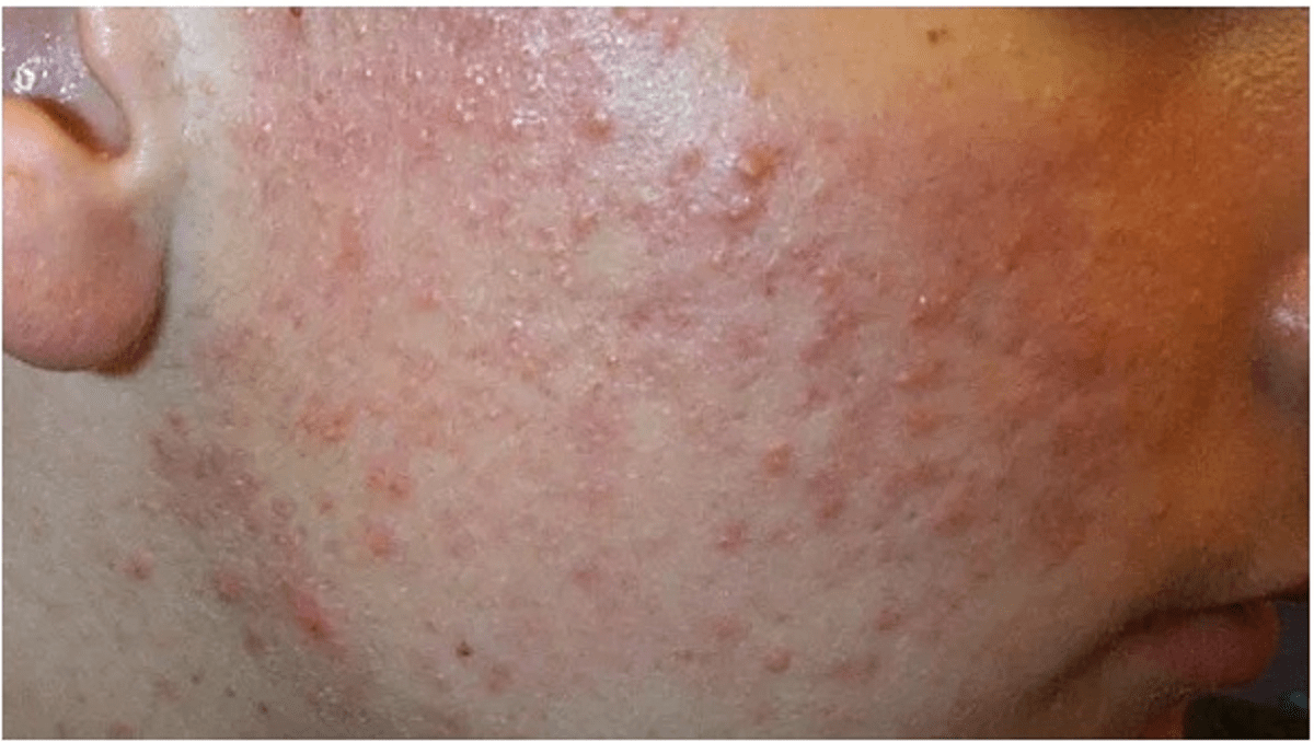 تمام چیزهایی که باید در مورد ضایعات پوستی و علائم و نشانه های آن بدانیم