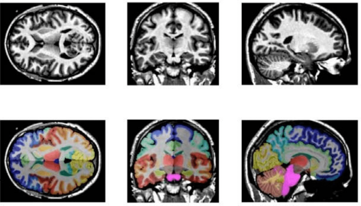 Brain MRI Segmentation AI Models