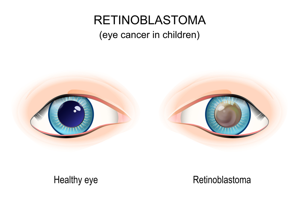 Can Retinoblastoma Be Fatal? Raynes & Lawn