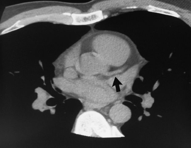 How Healthy Is Your Heart? RAYUS Radiology