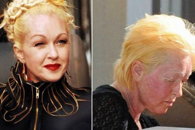 Cyndi Lauper’s Journey From Psoriasis Struggles to Iconic Advocacy