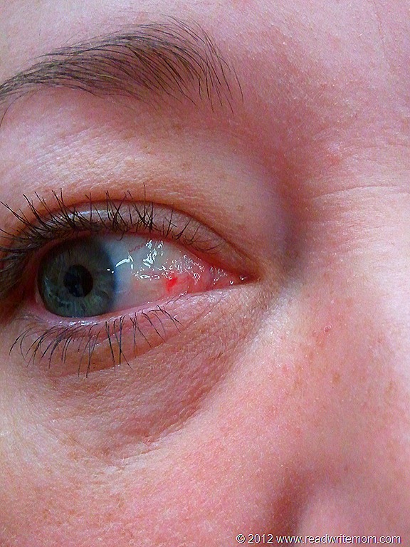 There’s A Red Bump On My Eyeball
