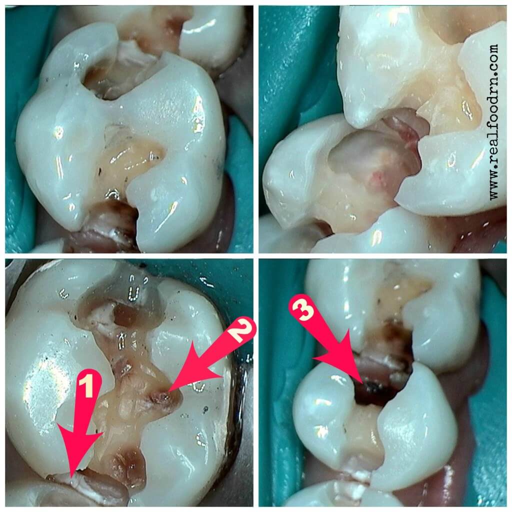 Removing My Amalgam Fillings