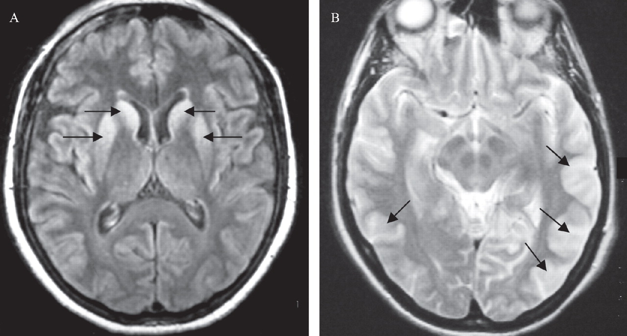 CreutzfeldtJakob Syndrome; New Variant CreutzfeldtJakob Disease