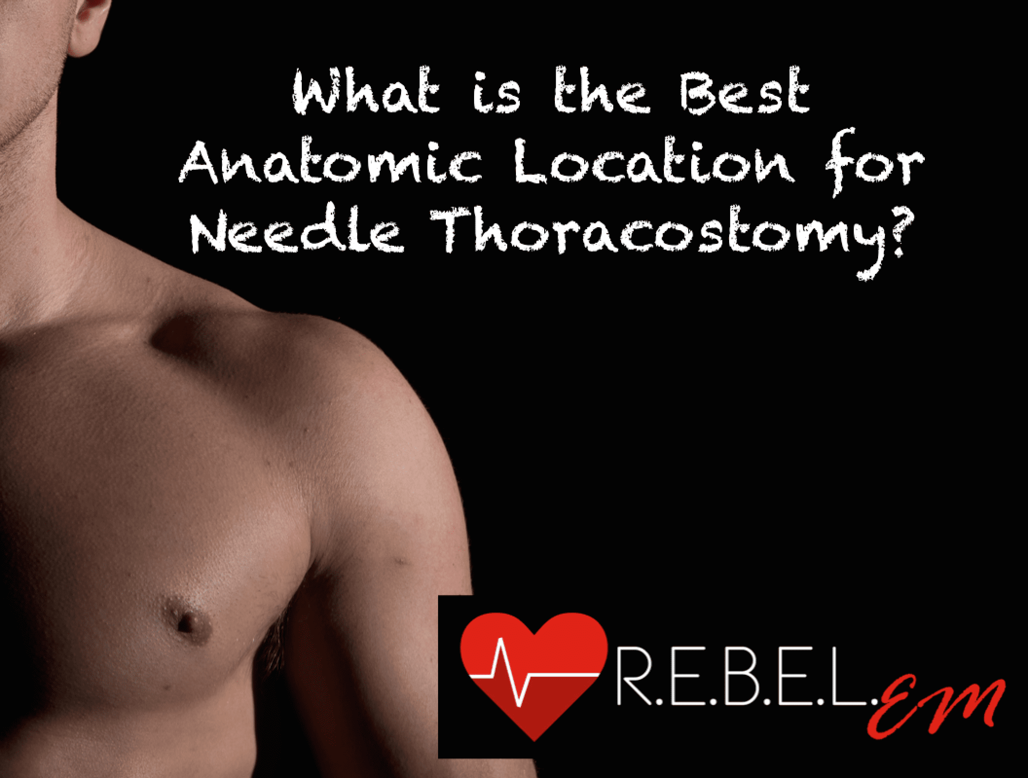 What is the Best Anatomic Location for Needle Thoracostomy? R.E.B.E.L