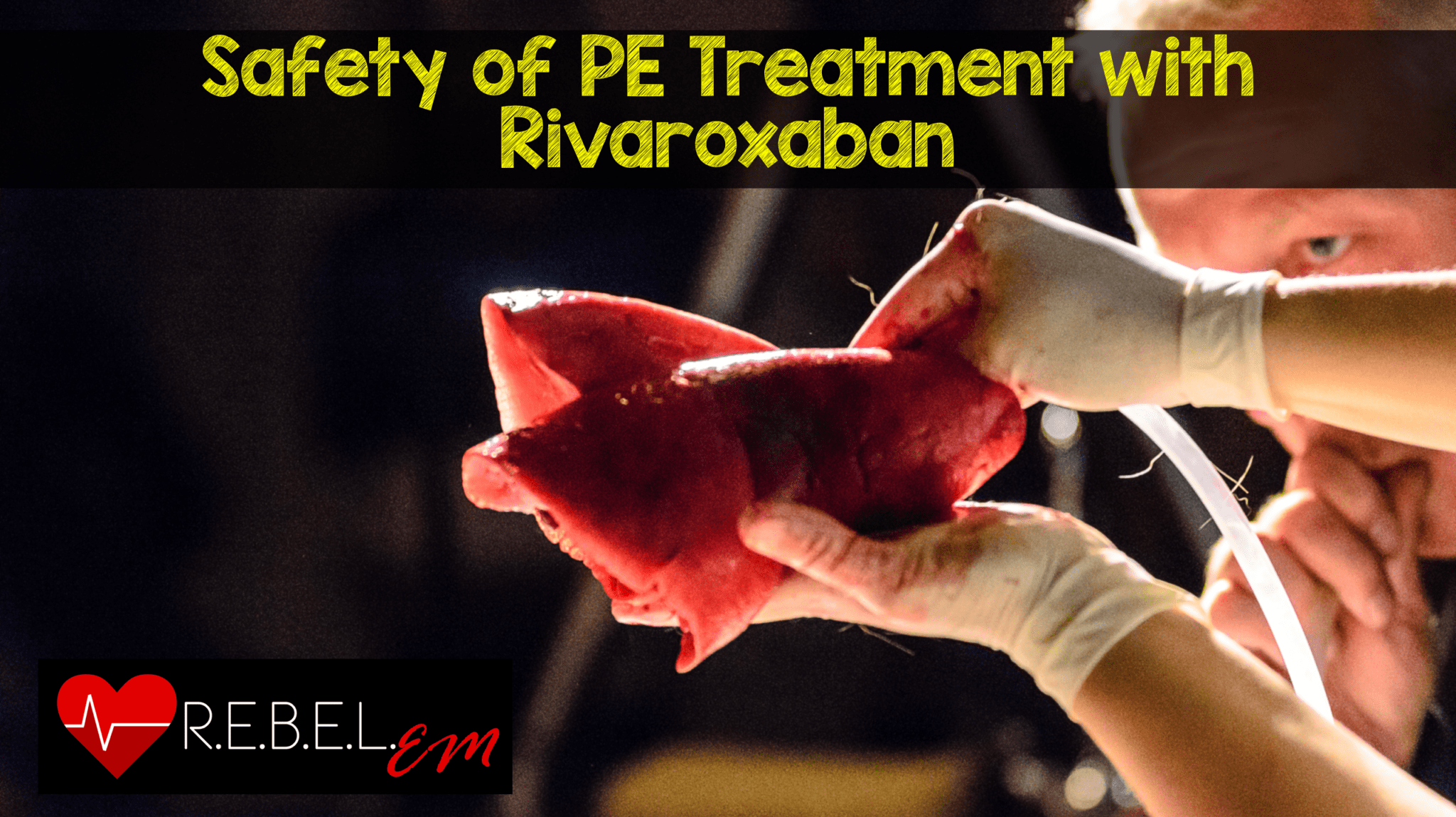Rivaroxaban REBEL EM Emergency Medicine Blog