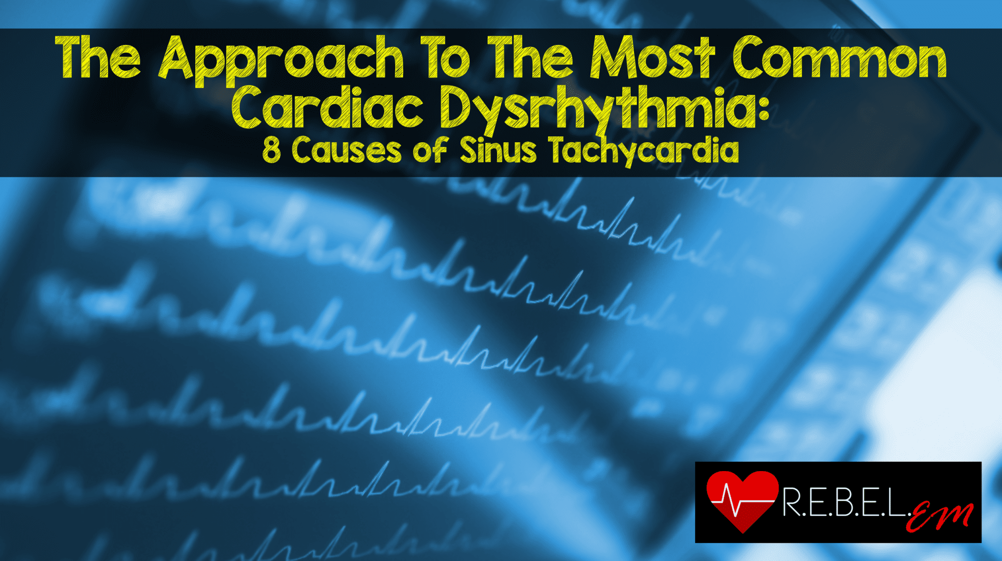 The Approach To The Most Common Cardiac Dysrhythmia 8 Causes of Sinus
