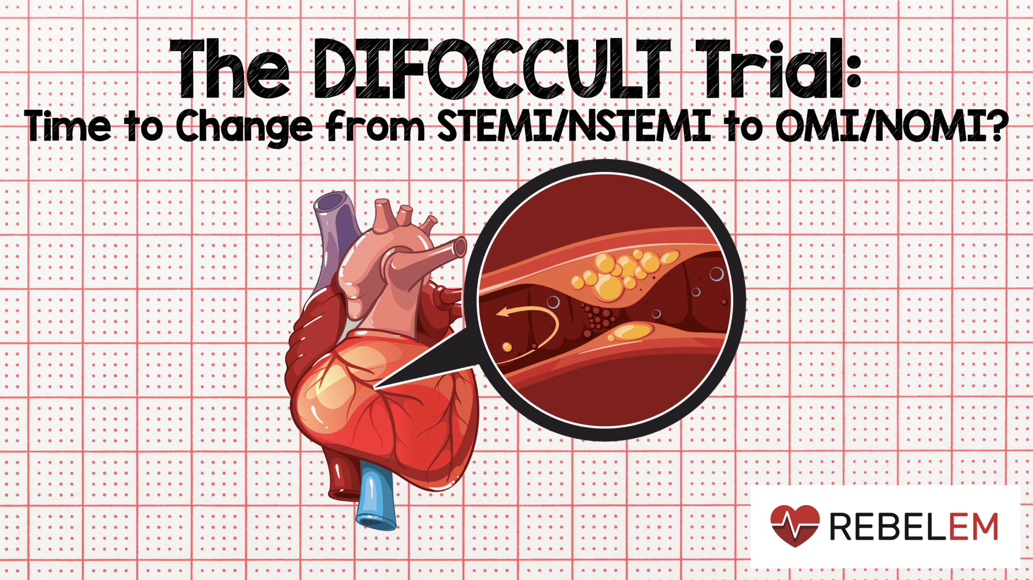 The DIFOCCULT Trial Time to Change from STEMI/NSTEMI to OMI/NOMI