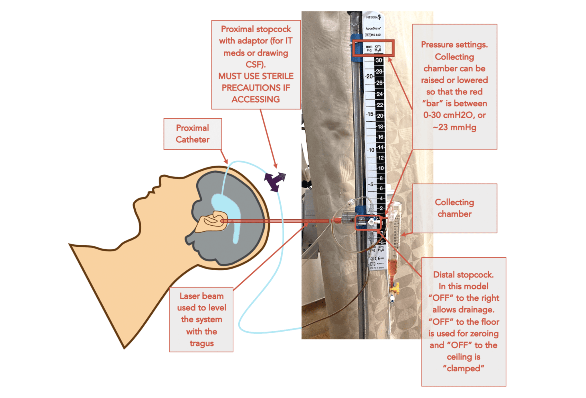 EMCrit EVD Drain Setup REBEL EM Emergency Medicine Blog