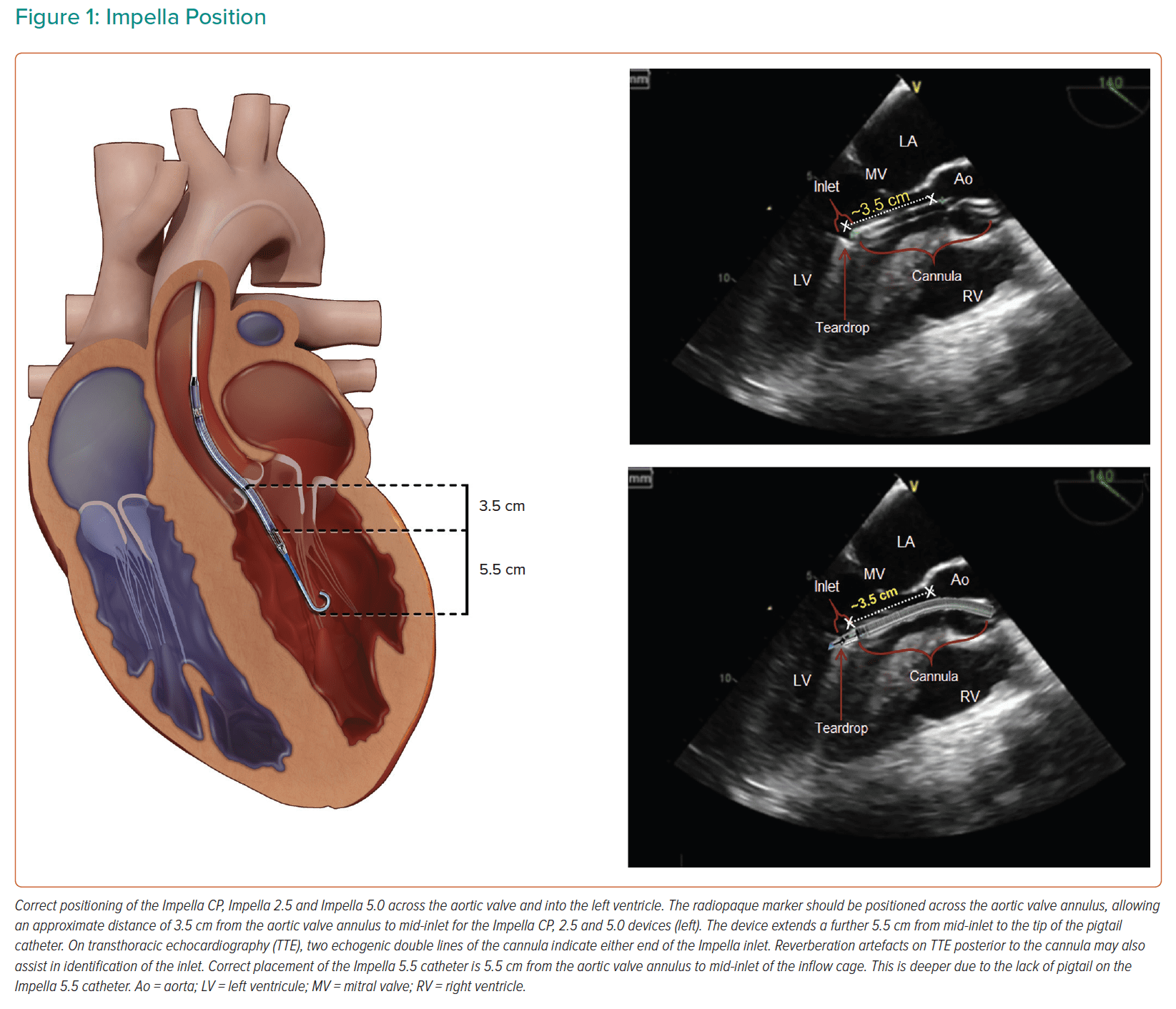 Impella Devices 101 MEDTAC International Corp.