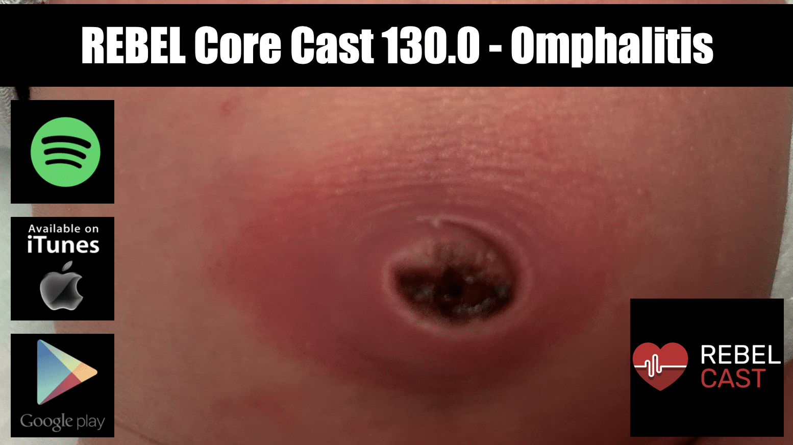 REBEL Core Cast 130.0 Omphalitis REBEL EM Emergency Medicine Blog