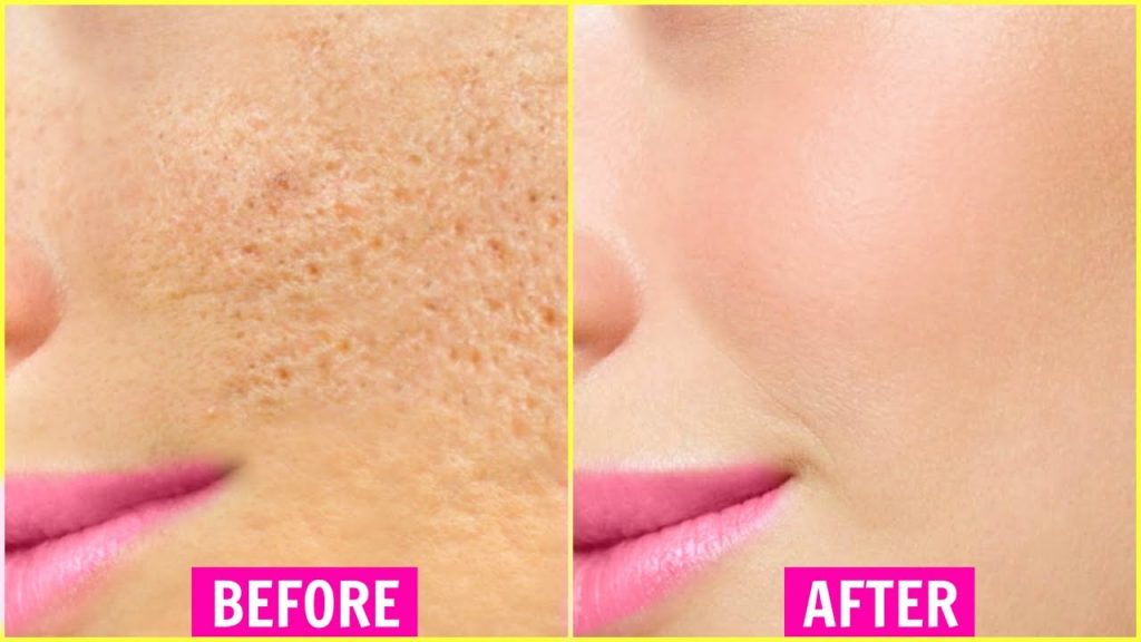 How To Get Rid Of Open Pores Permanently Recibeauty
