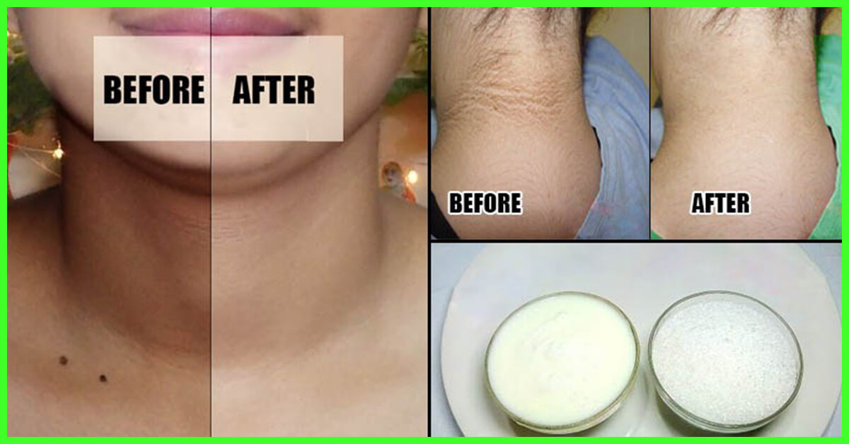 Black Neck Home Remedies Recipes and Beauty Tips Recibeauty