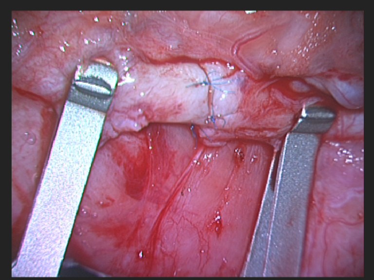 Vasectomy Reversal Surgery Successful microsurgical