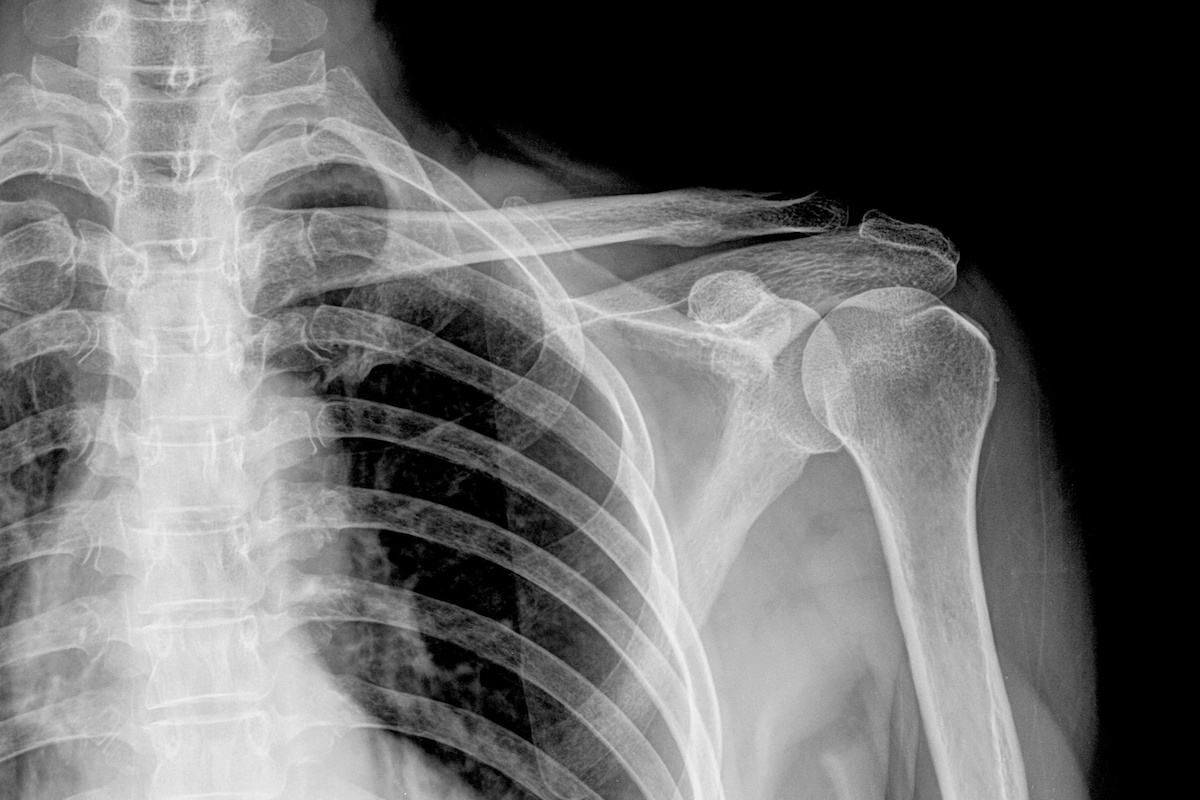 The Upside of a Broken Shoulder Redhead Ranting